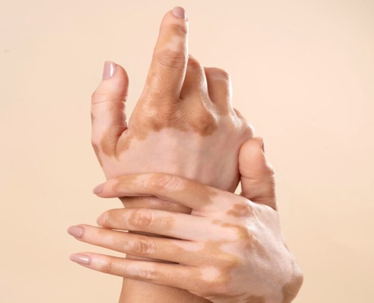 young-woman-showing-her-vitiligo-skin-parts (1)