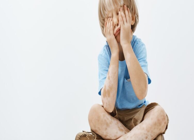 indoor-shot-cute-european-child-with-lovely-haircut-vitiligo-covering-face-with-palms-while-sitting-playing-hide-seek-with-older-brother (1)